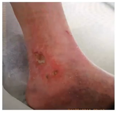 Sore on bottom online of foot not healing